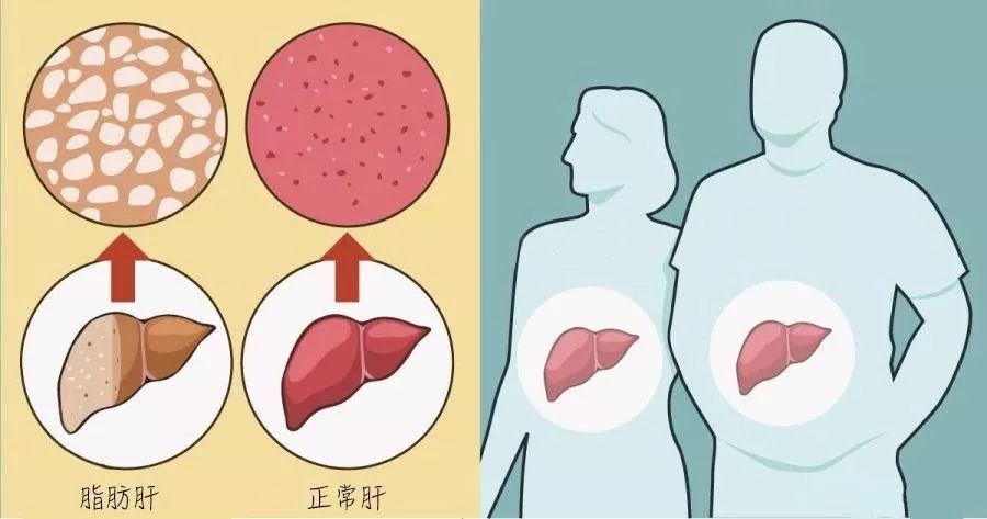 脂肪肝和正常肝的对比
