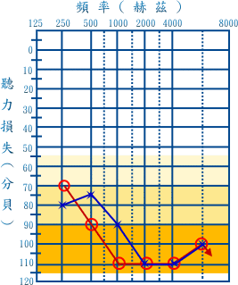 认识听力图