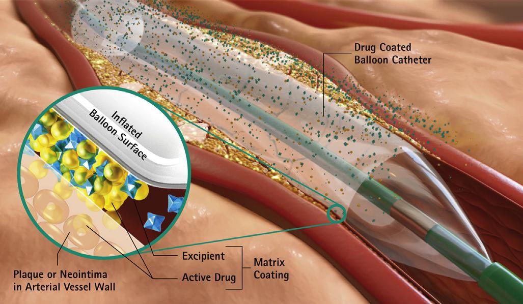据了解,冠脉内局部药物释放治疗术主要由药物涂层球囊(dcb)技术提供
