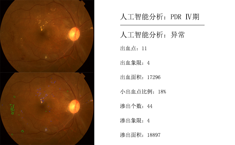 PDRⅣ期