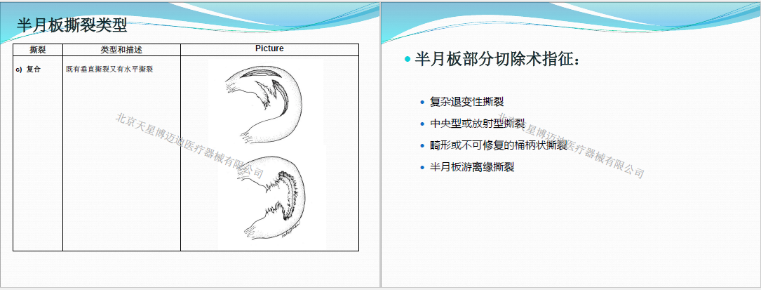 半月板缝合技术-北京天星博迈迪医疗器械有限公司