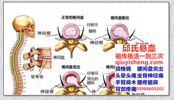 腰椎间盘突出的三种自我治疗方法-邱氏悬壶