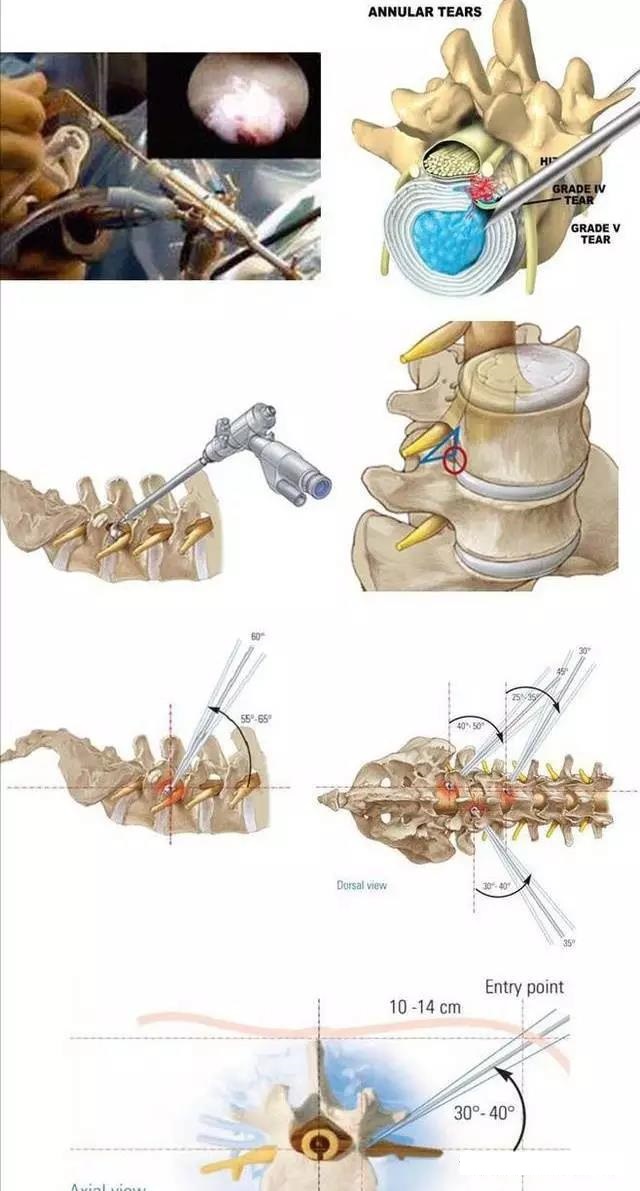部位不同,从背部侧方或后放入路,进入椎间孔,在安全三角区,椎间盘纤维