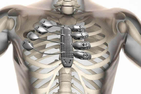 6应用领域--人体生物人体肋骨