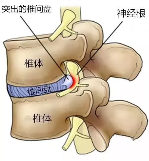 如何初步判断自己有没有腰椎间盘突出症