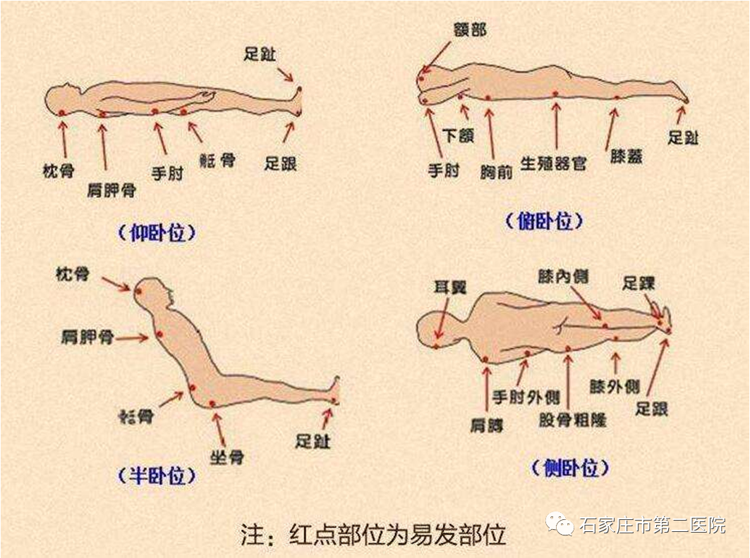 新型冠状病毒肺炎患者俯卧位治疗上海专家建议_进行_oxygen_重症