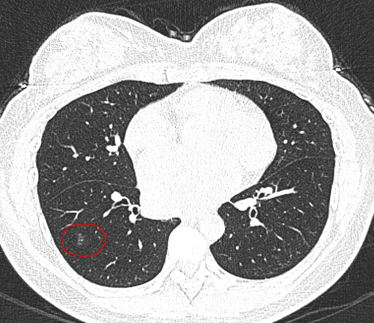 (胸部ct提示:右肺下叶外侧基底段磨玻璃结节)