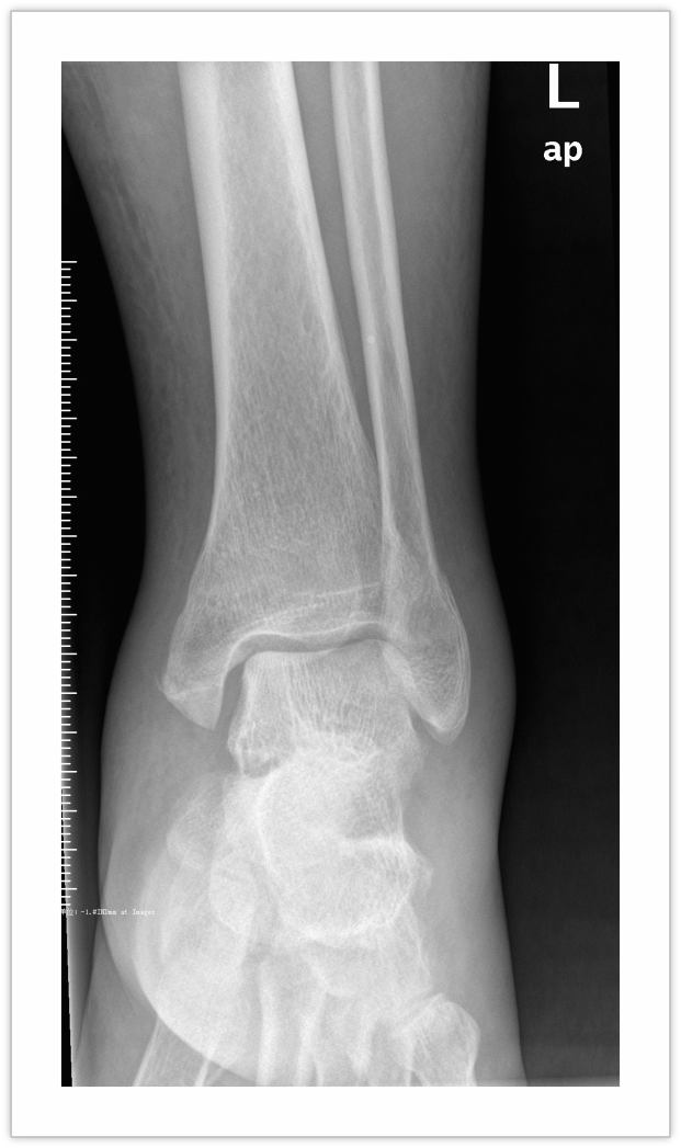 术前dr检查沈大爷踝关节骨折为关节内骨折,加之骨折移位大于2mm必须