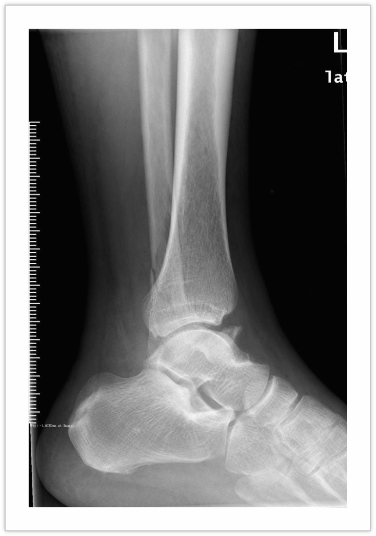 术前dr检查术前ct三维成像检查沈大爷踝关节骨折为关节内骨折,加之
