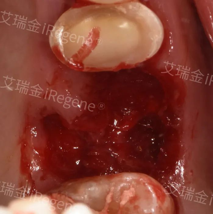 病例膠原塞在口腔臨床殘根拔除病例中的實際應用