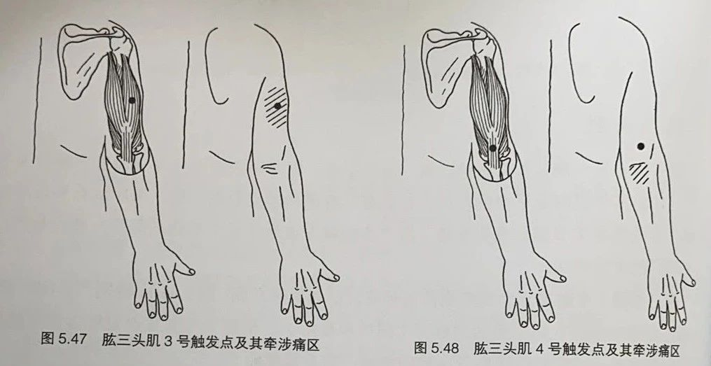 疼痛有時會往下擴散到前臂後區 位於肱三頭肌外側頭,引起的疼痛在它