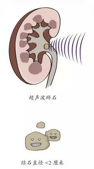 深入了解体外冲击波碎石术-盱眙楚东医院