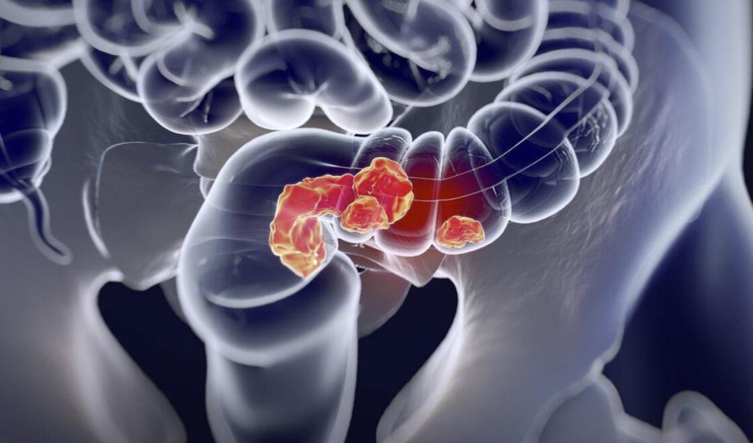 新型冠状病毒检测预约59后一个:泛癌种结直肠癌在我国的发病率和