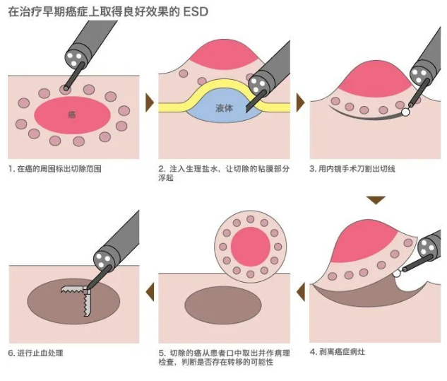 菏泽市定陶区人民医院成功开展内镜下食管粘膜剥离术esd