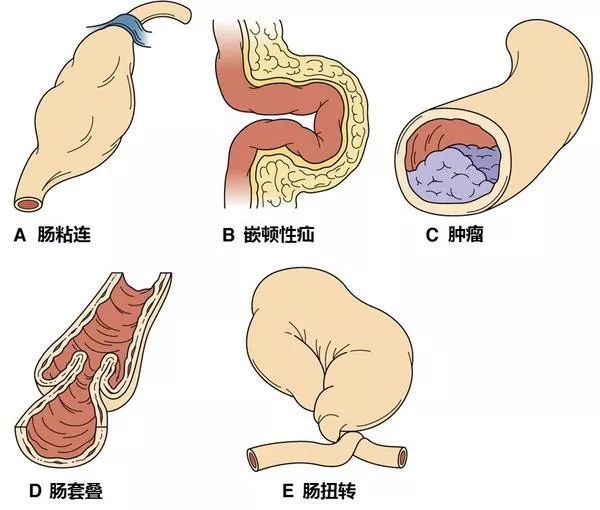 医学上,根据肠梗阻的病因,将其简单的分为机械性肠梗阻,动力性肠梗阻