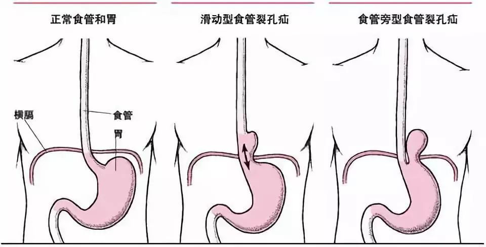 腹腔镜疝气修补术图解图片