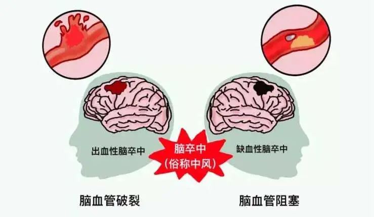 脑卒中逐渐年轻化小心被盯上