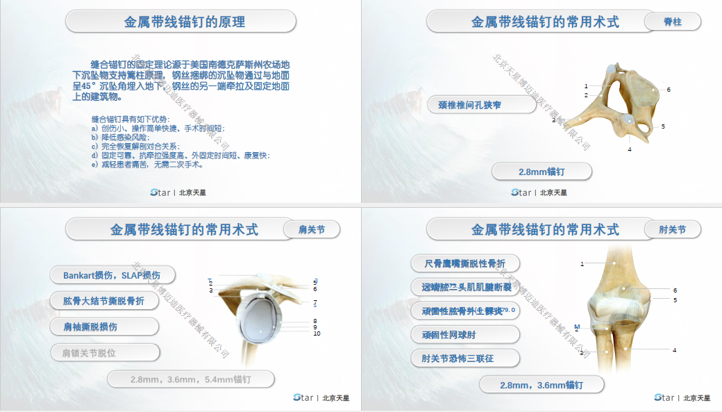 医用带线锚钉,带线锚钉_大山谷图库