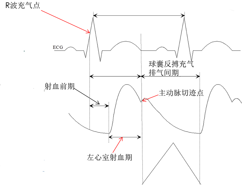 主动脉内球囊反搏iabp管理