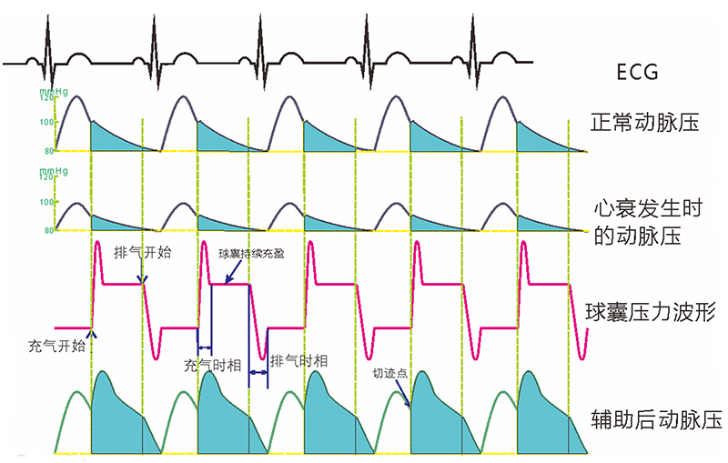 标准脉搏波形图图片