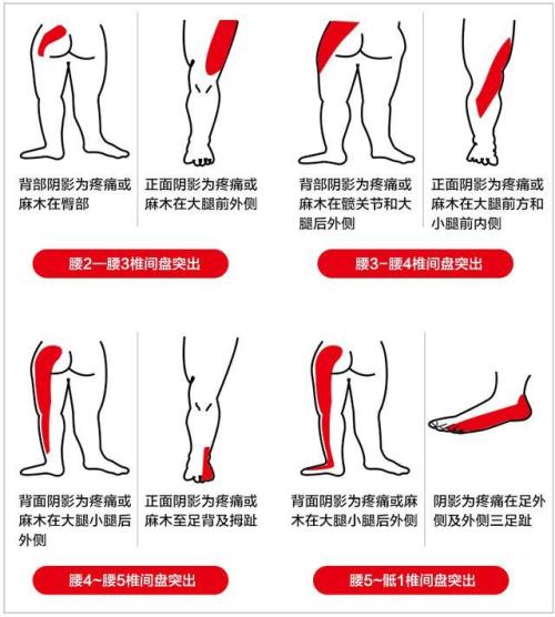 延安椎间盘突出邱悬壶图片