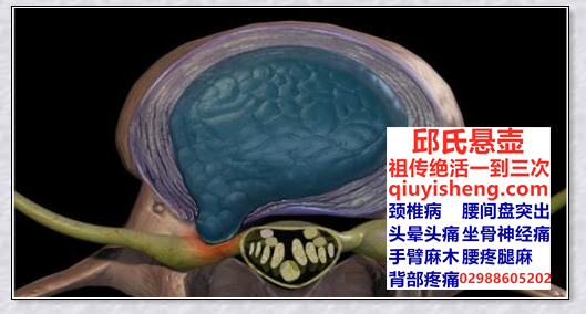 什么是腰间盘突出-西安邱氏悬壶官网