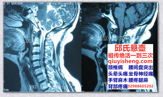 颈椎突出的治疗方法 邱氏悬壶