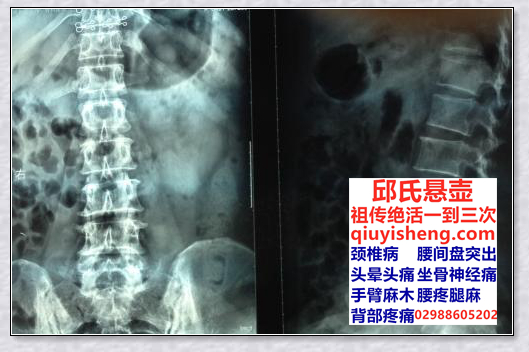 腰间盘突出0456