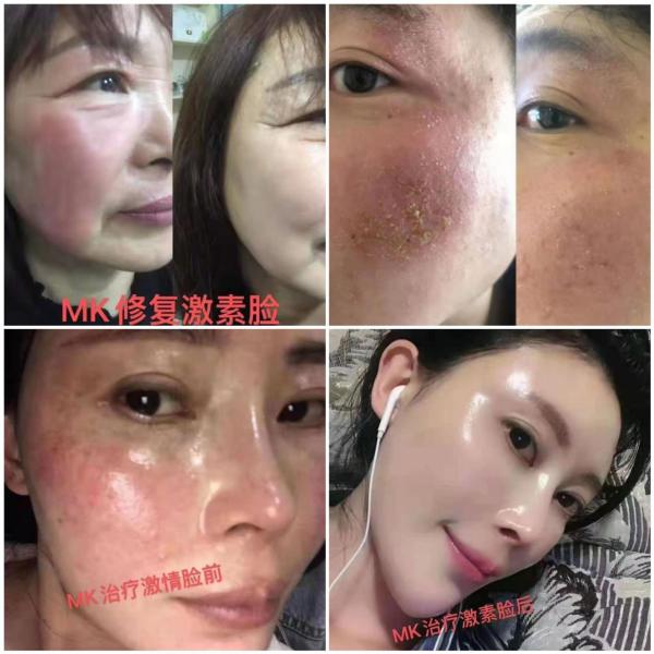 香港维特丽雅mk素颜美肌治好激素脸要几个疗程?后期会反弹吗?