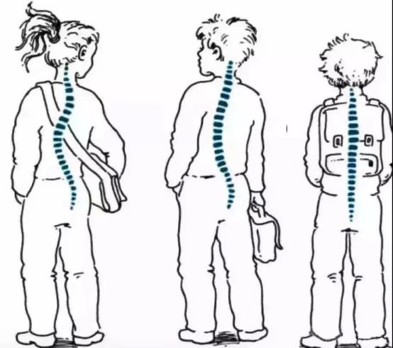 脊柱侧弯1