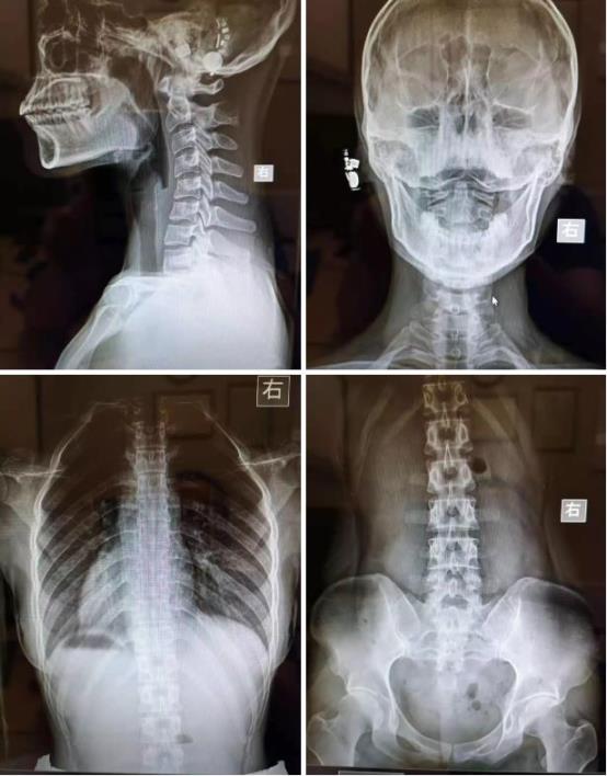 脊柱侧弯4