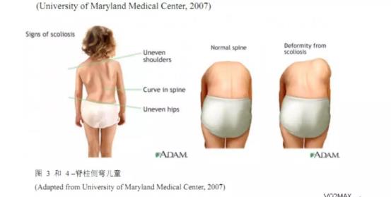 脊柱侧弯5