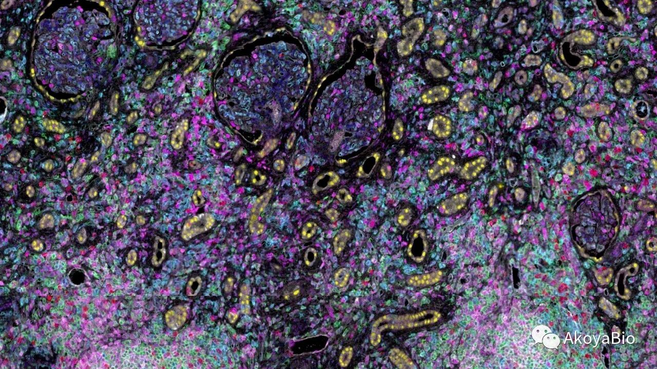 天文學結合病理學-利用多重免疫熒光技術發現和臨床驗證新的空間表型