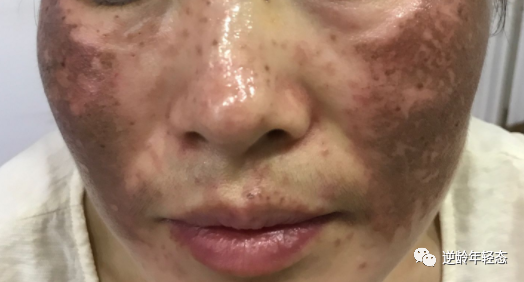 科普:14种不同的色斑,你能分得清吗?-壹妍(yiyanguoji.