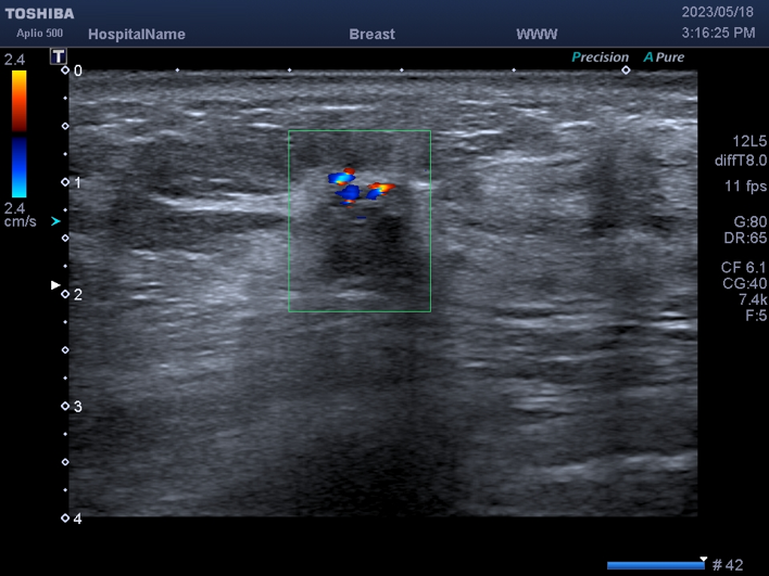 患者治疗前超声图像（血流）
