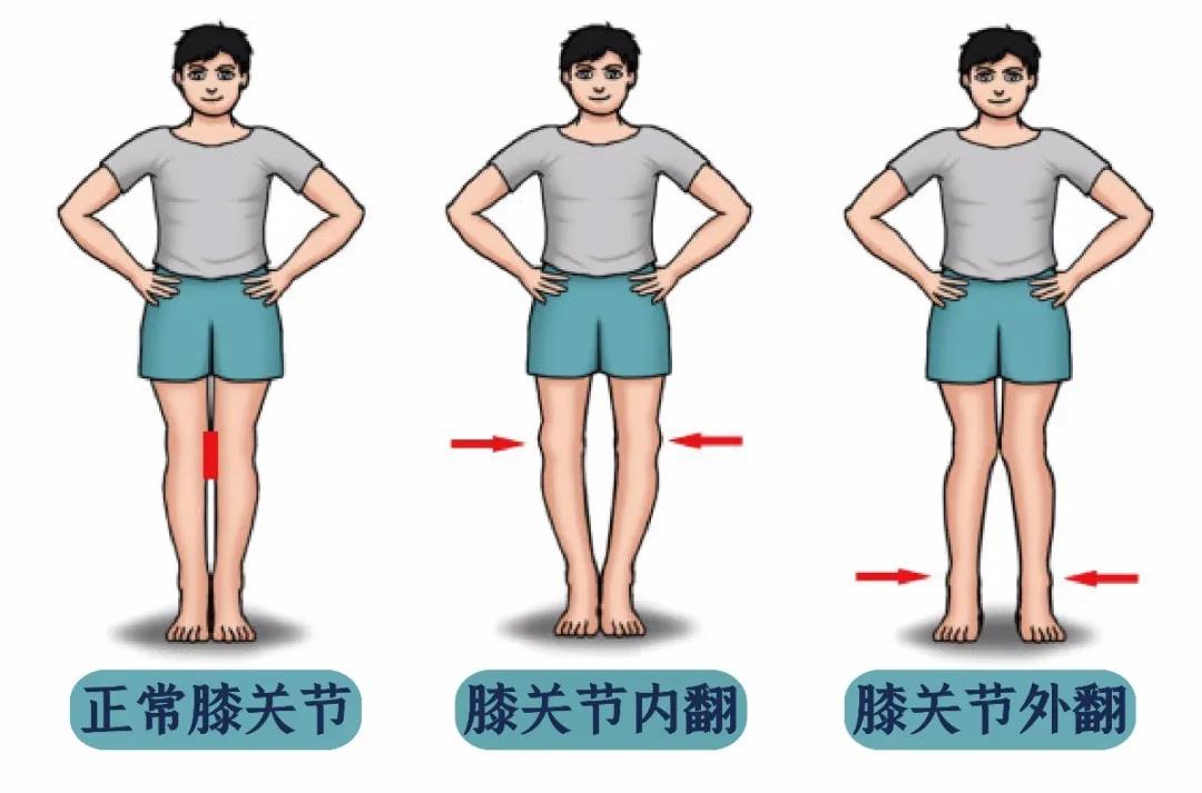 孩子腿不直教您正确认识x型和o型腿