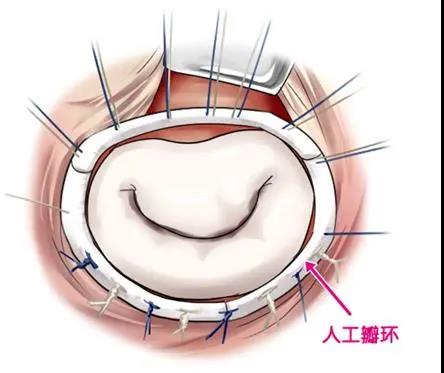 目前,对于需要外科手术的心脏瓣膜疾病,采用瓣膜成形术与瓣膜置换术均
