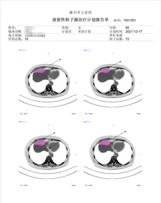 晚期肿瘤患者的福音 125i放射性粒子植入——杀入肿瘤内部的“核导弹” 广东省人民医院赣州医院（赣州市立医院）