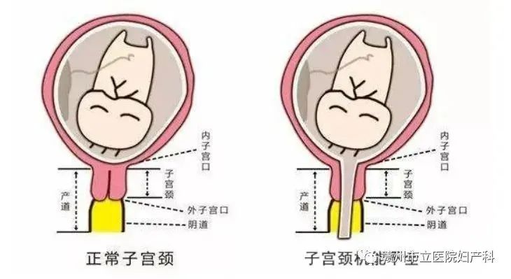 宮頸環扎媽媽生二胎啦經腹腔鏡下宮頸內口環扎術讓保胎不再難