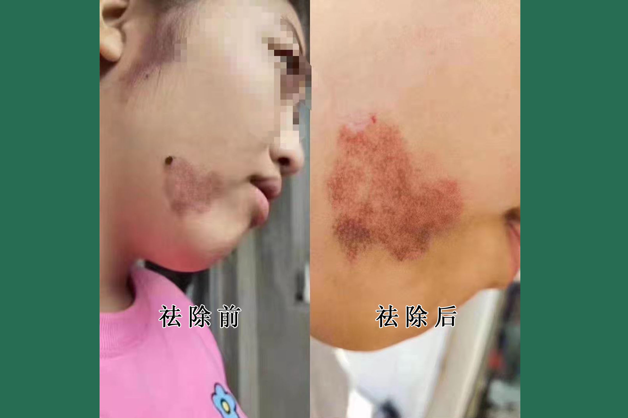 祛除咖啡色胎记