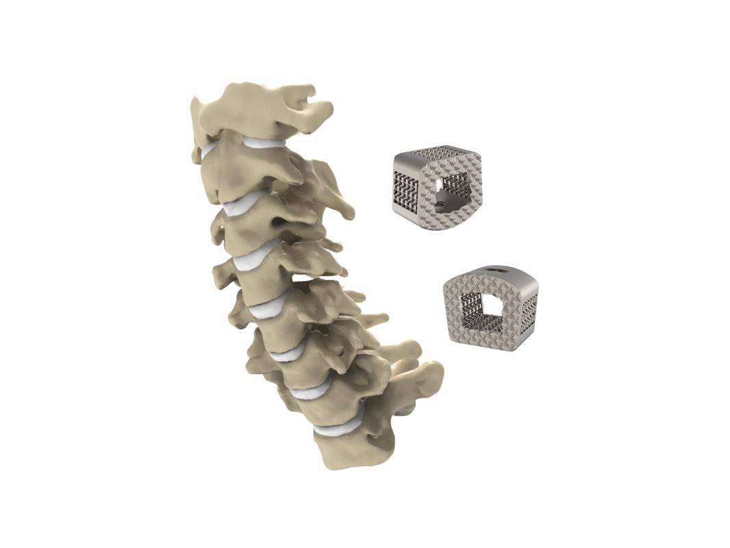 ZSFAB Receives FDA 510(k) Clearance for 3D-Printed Cervical 