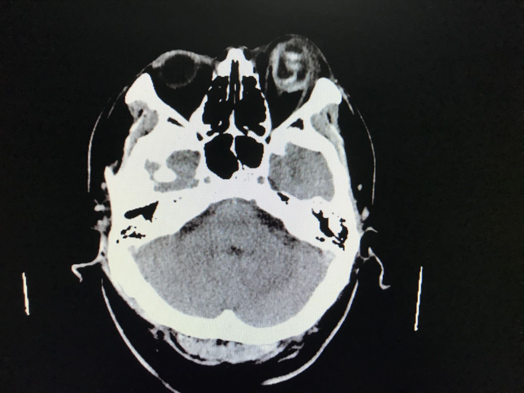 入院後行眼眶ct:左眼球損傷,球內出血,晶狀體位置異常.