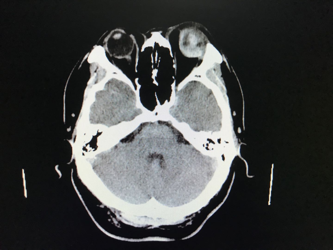 入院后行眼眶ct:左眼球损伤,球内出血,晶状体位置异常.