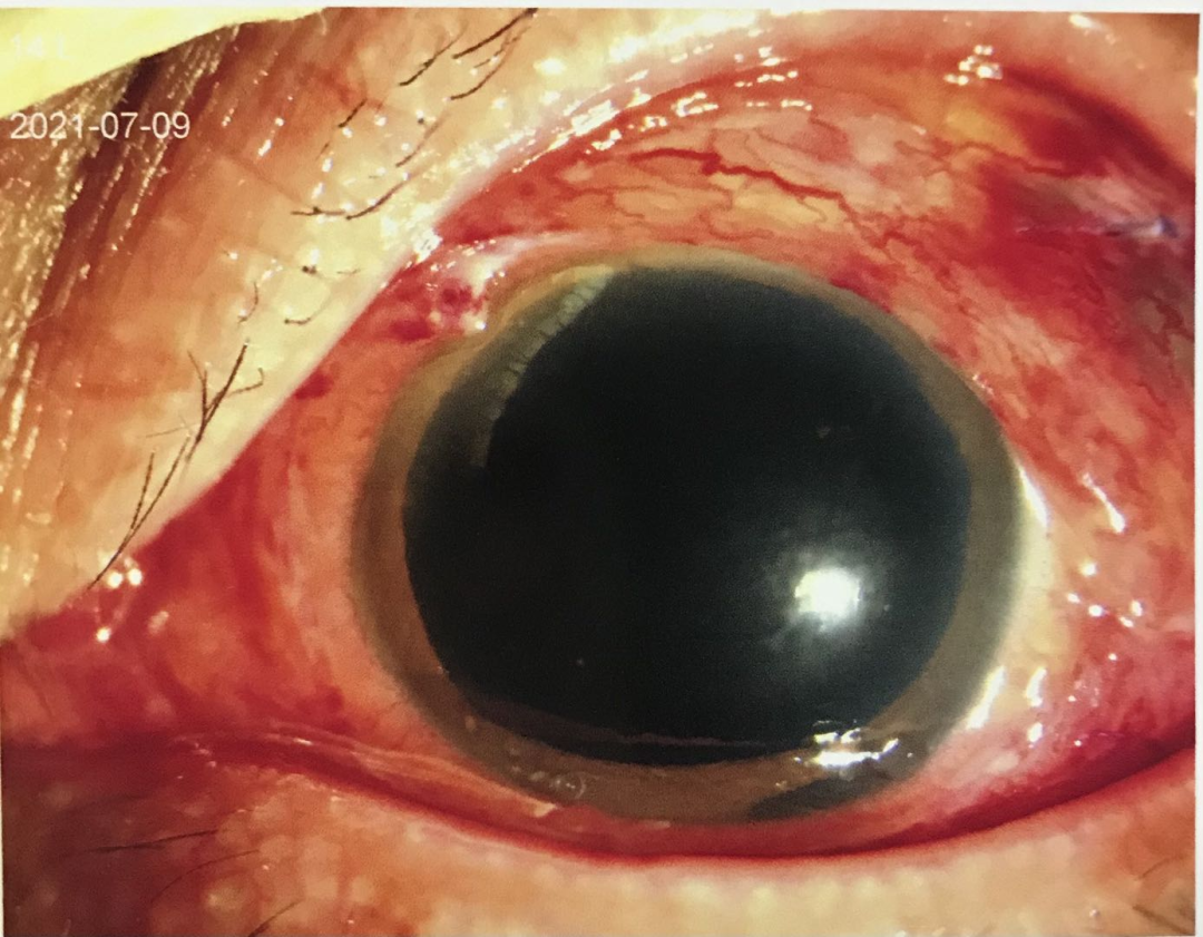 眼球钝挫伤所致的巩膜裂伤较多见,但位于赤道后的裂伤由于伤口比较