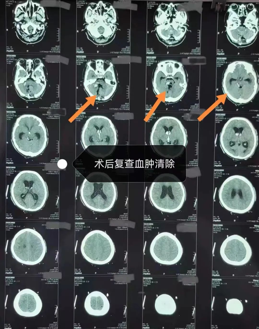 命懸一線妙手回春我院神經外科團隊成功為一腦幹出血患者行手術治療