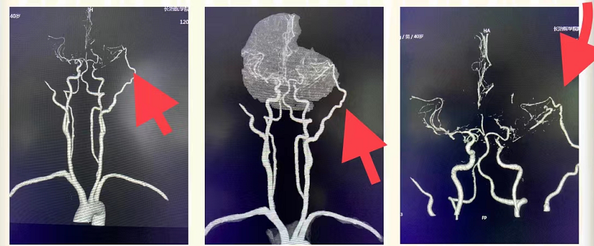 直径1毫米血管上穿针引线和济医院颅内外血管搭桥术治疗烟雾病