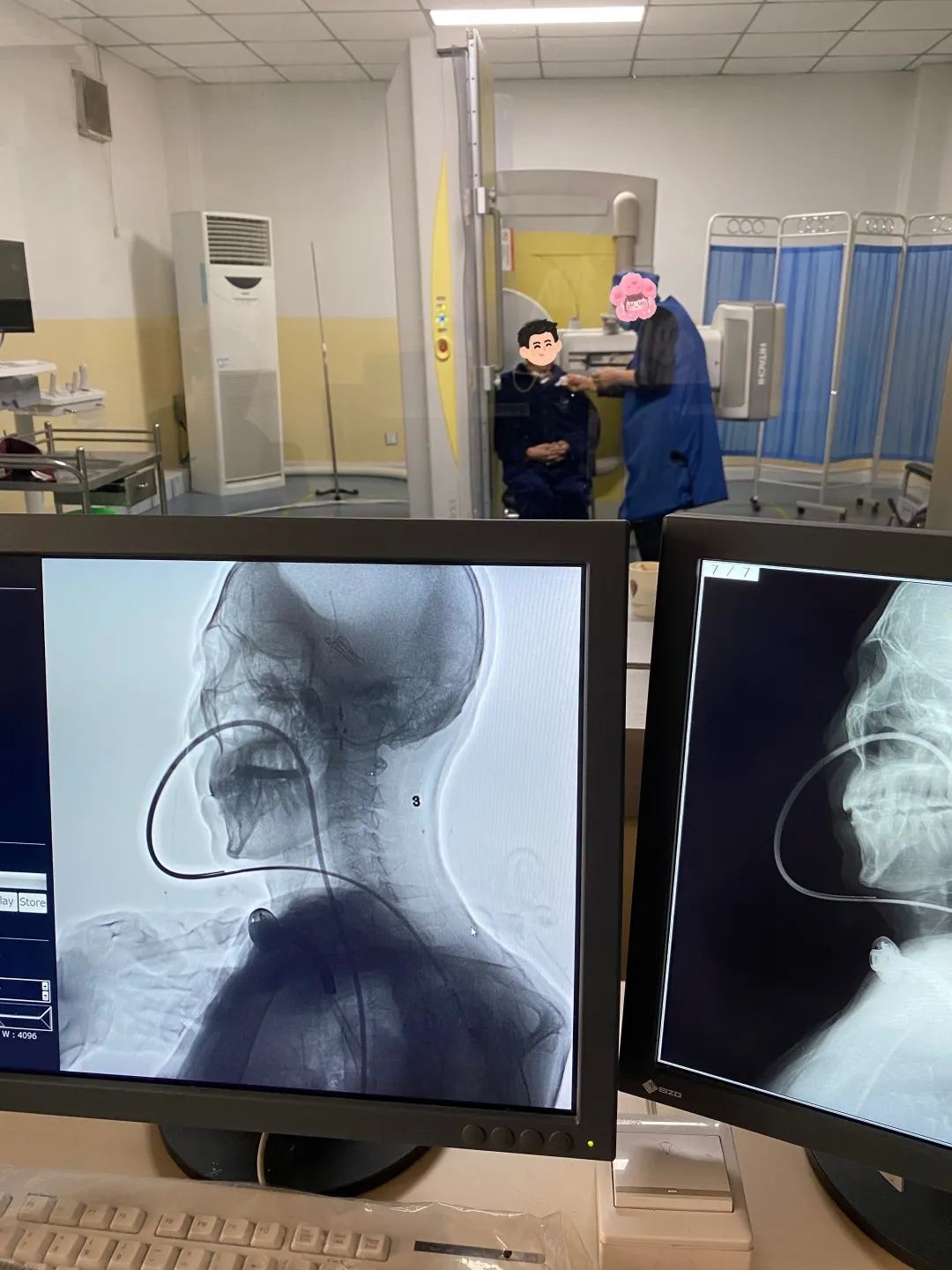 我院康复医学科联合影像科开展吞咽造影检查