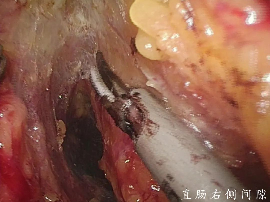 我院胃肠外科完成一例腹腔镜全结直肠系膜切除回肠j型储袋肛管吻合术