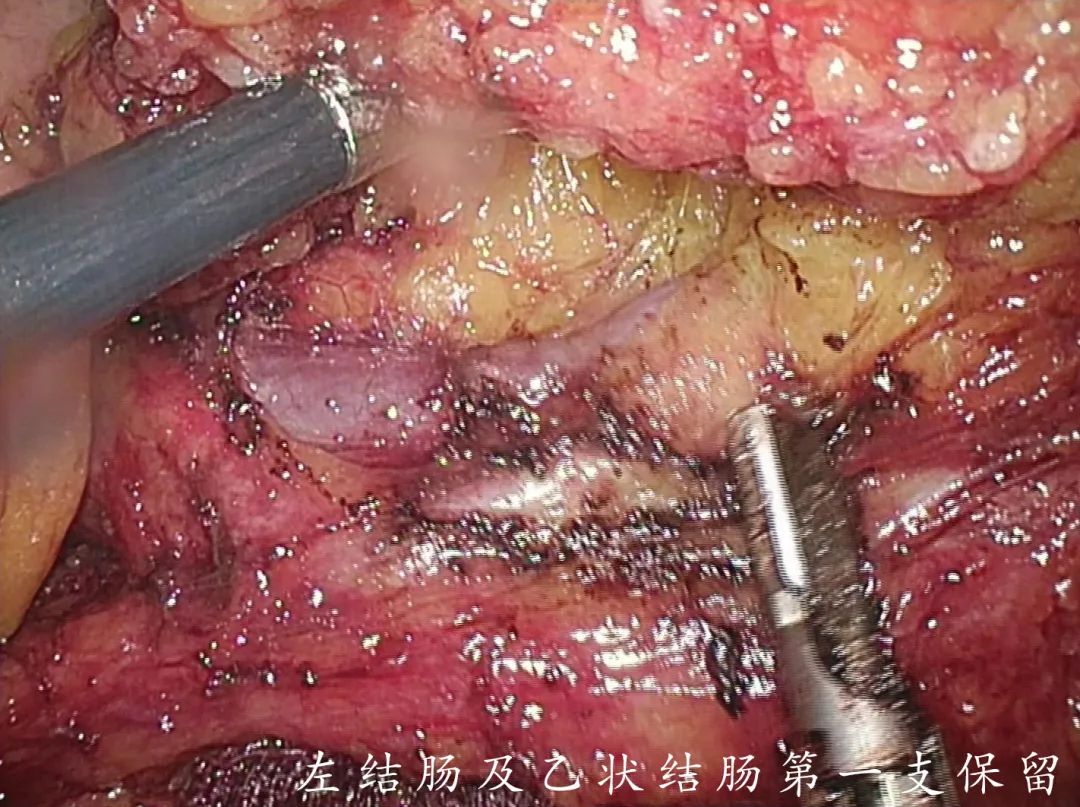 我院胃肠外科完成一例腹腔镜全结直肠系膜切除回肠j型储袋肛管吻合术