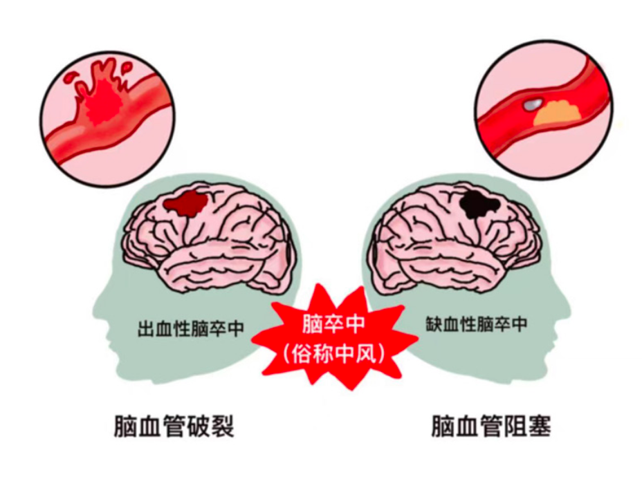 【健康大讲堂】脑卒中,重在预防!